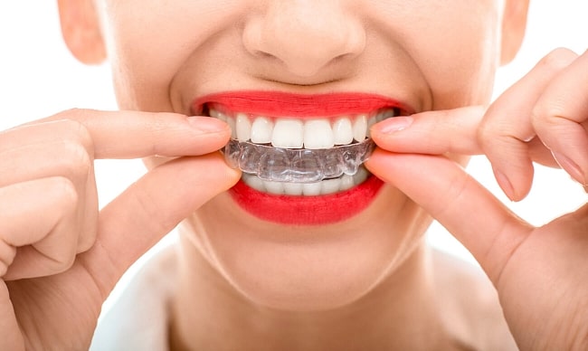 Елайнери Invisalign та їх переваги