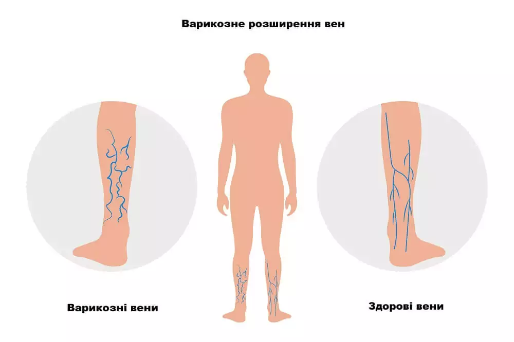 Симптоми варикозного розширення вен